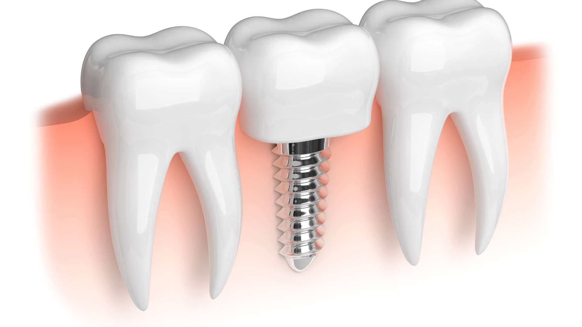 בחירת רופא שיניים בפתח תקווה לטיפולי השתלת שיניים