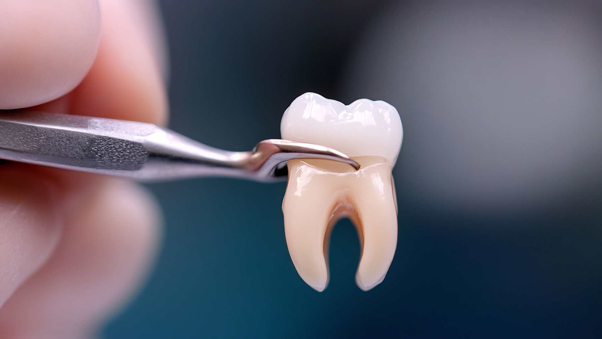 טעויות נפוצות אחרי עקירת שן בינה