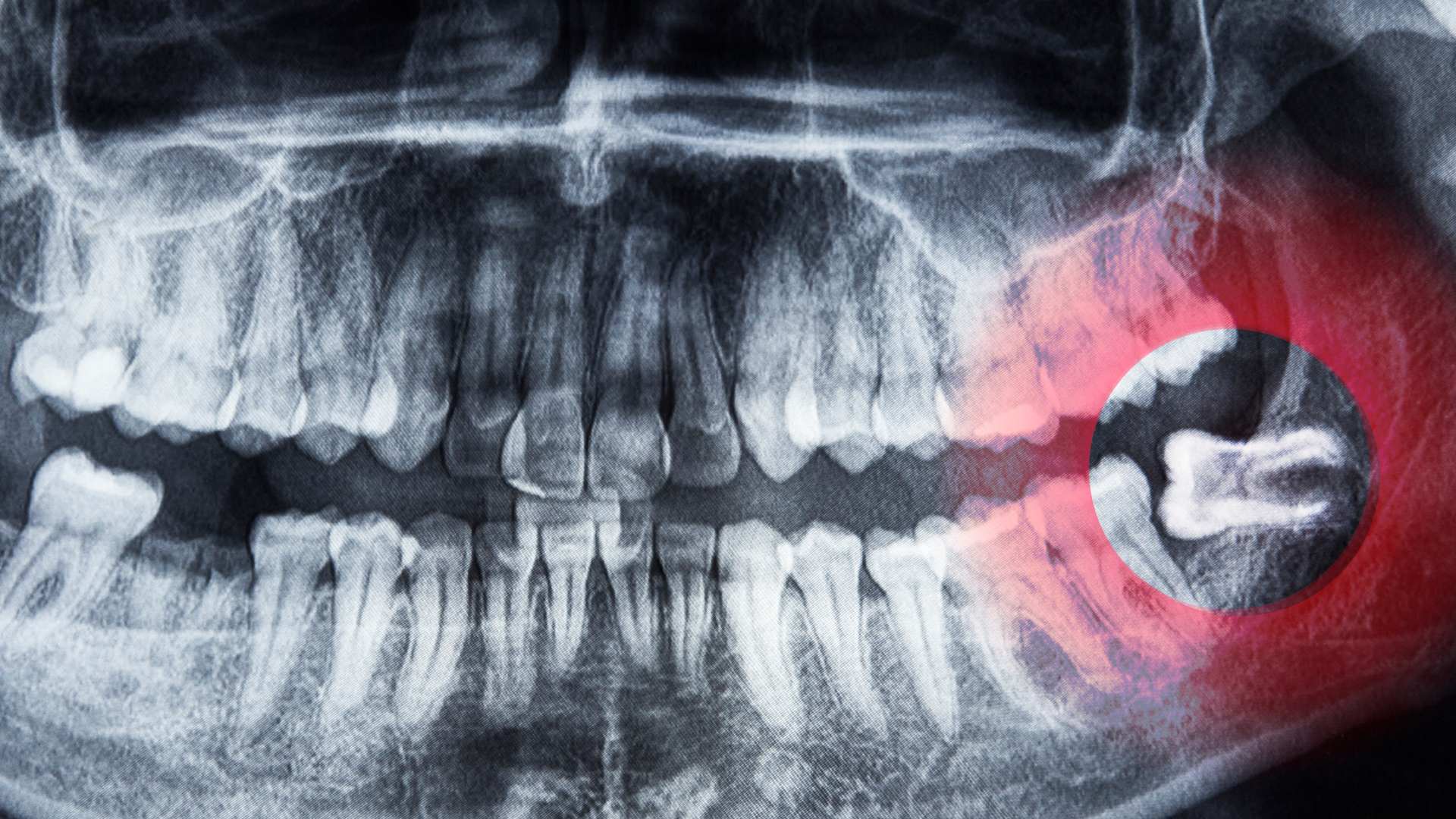 צילום של שן בינה כלואה
